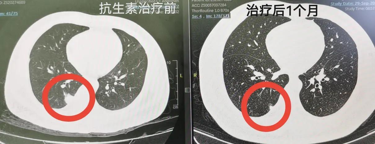 发现肺结节，需要用抗生素吗？