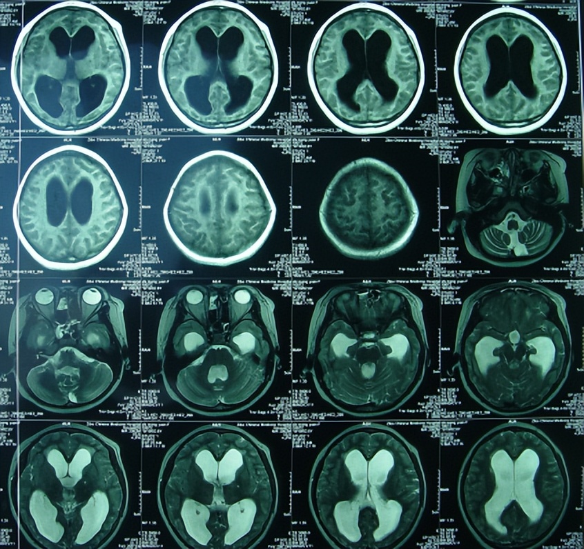 儿童结核脑膜炎脑积水,结核性脑膜炎脑积水如何引起