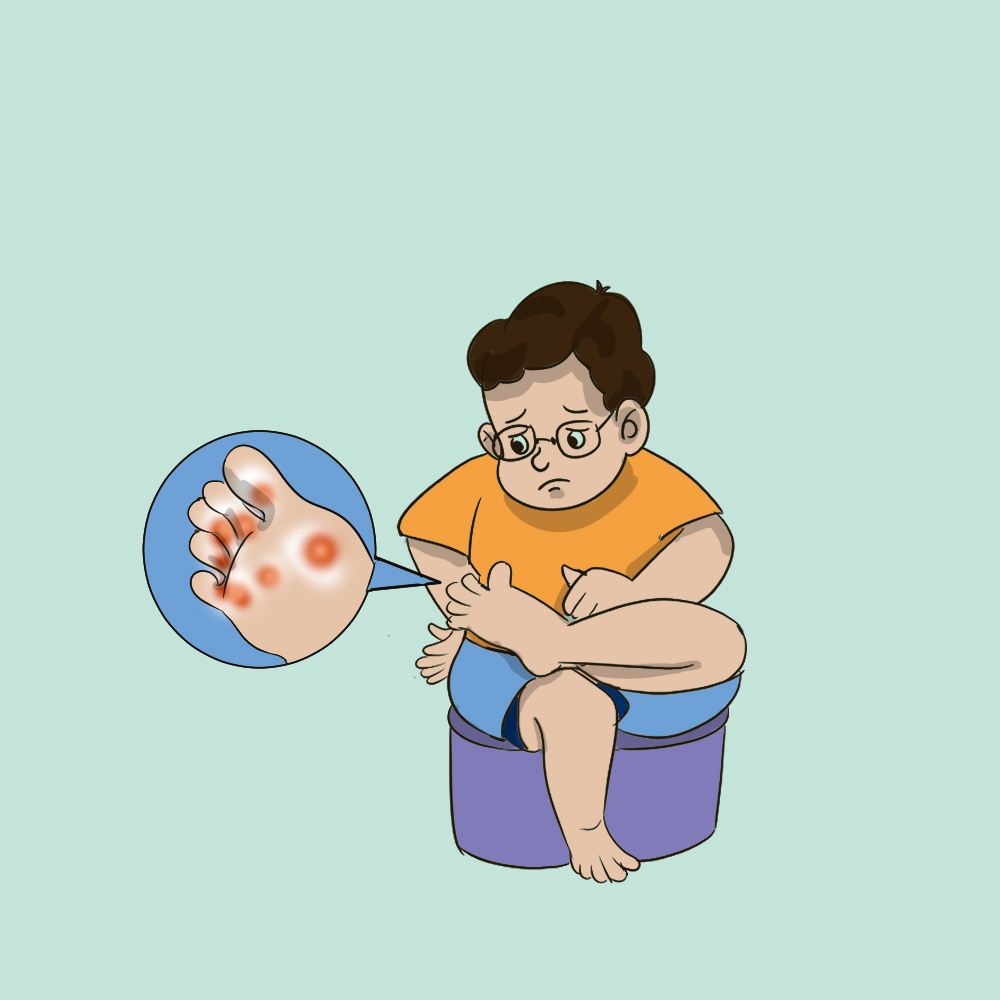 手足癣怎么治疗最有效,手足癣怎么治疗最快最有效