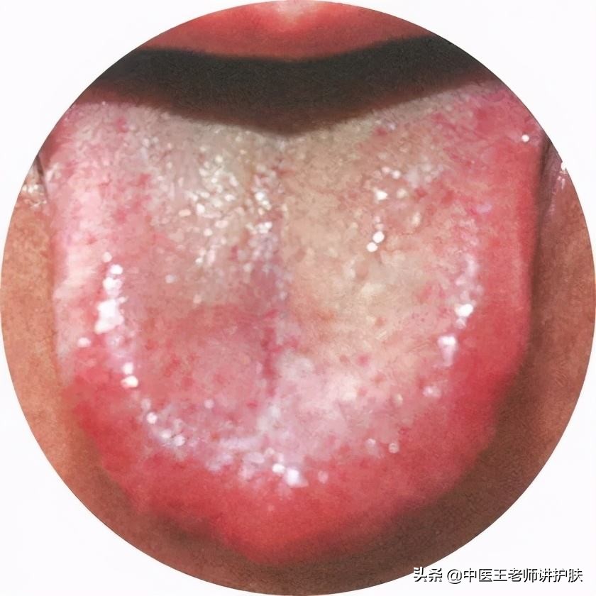 脓包型痘痘的治疗小偏方,治疗痘痘及脓疮最好的偏方