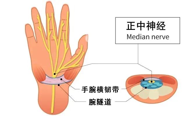 手麻腕管综合征,手指麻是腕管炎吗