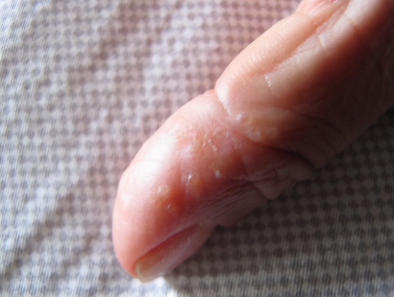 手上的水泡是脚气还是汗疱疹,手上起小水泡很痒怎么办看什么科