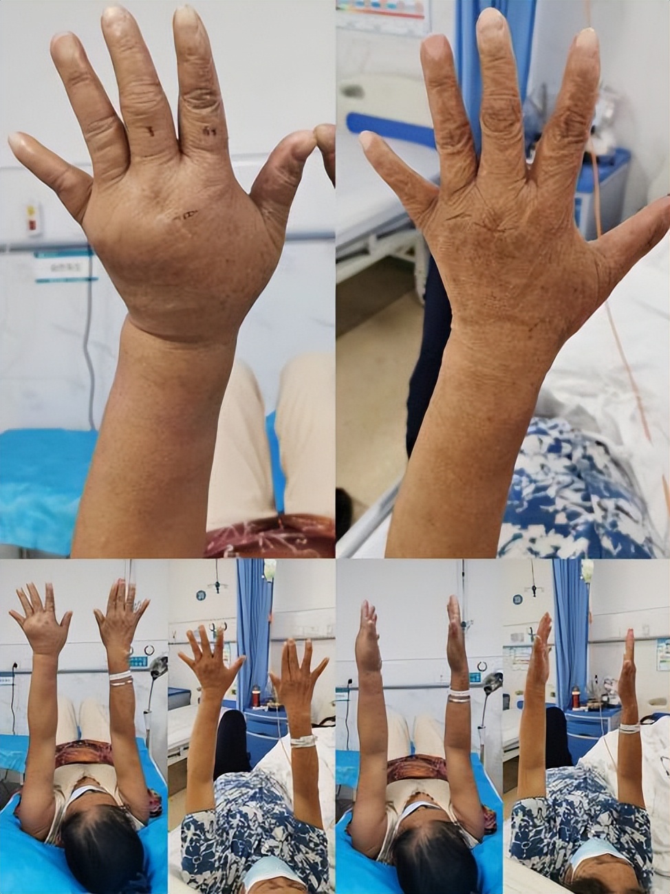 淋巴水肿外阴肿怎样锻炼,淋巴水肿引起腿肿怎么治