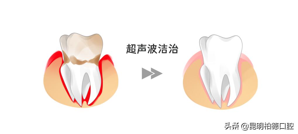 洗牙喷砂和龈下刮治的区别,洗牙套餐里喷砂是什么意思