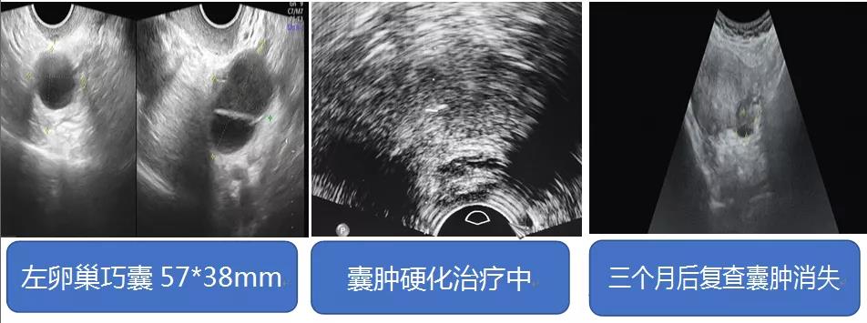 “针尖上的艺术”——各部位囊肿硬化治疗