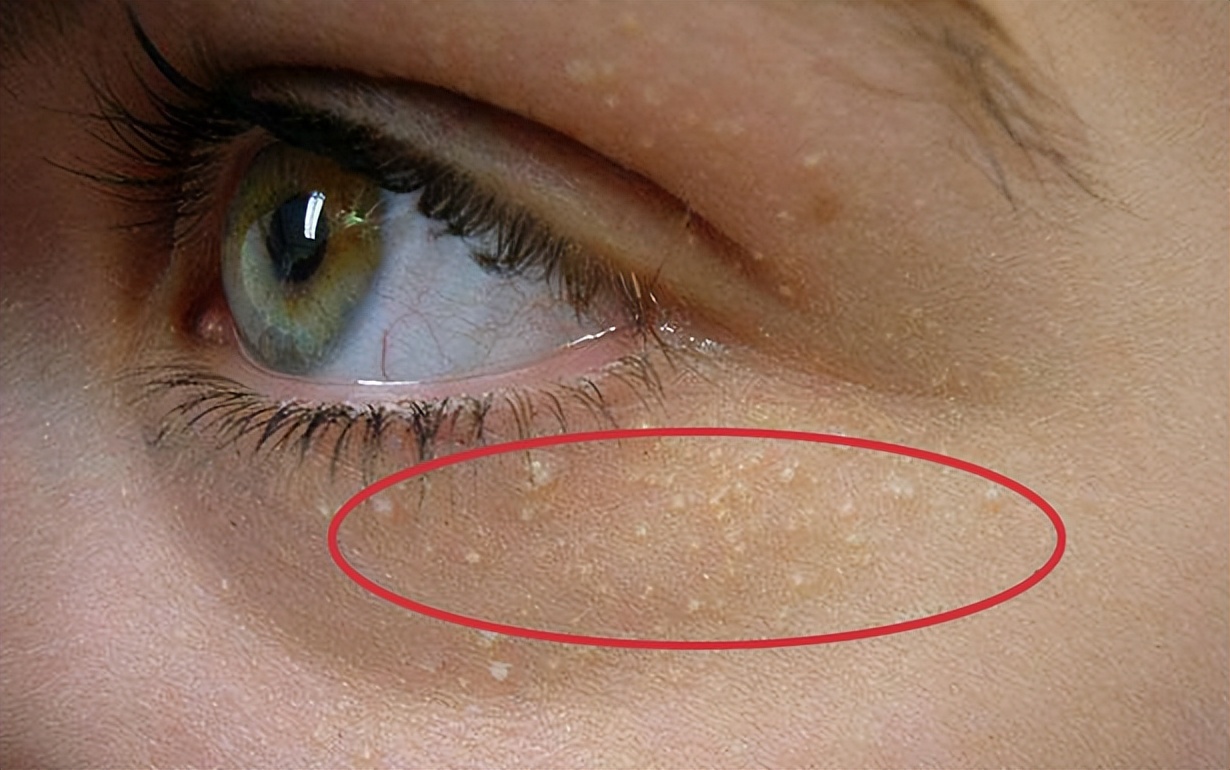 腋下有小肉粒是hpv感染会怎么样,腋下长小肉粒是hpv感染吗怎么治疗