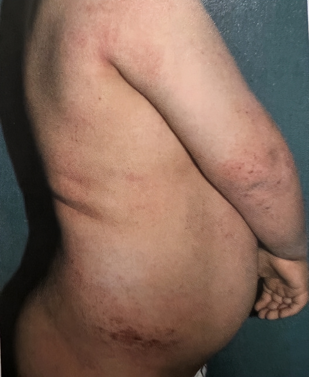 特应性皮炎中医疗法,特应性皮炎忌口食物一览表