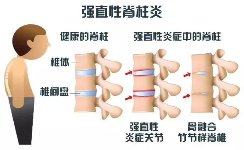 强直性脊柱炎的症状是什么,强直性脊柱炎脊椎是什么样的