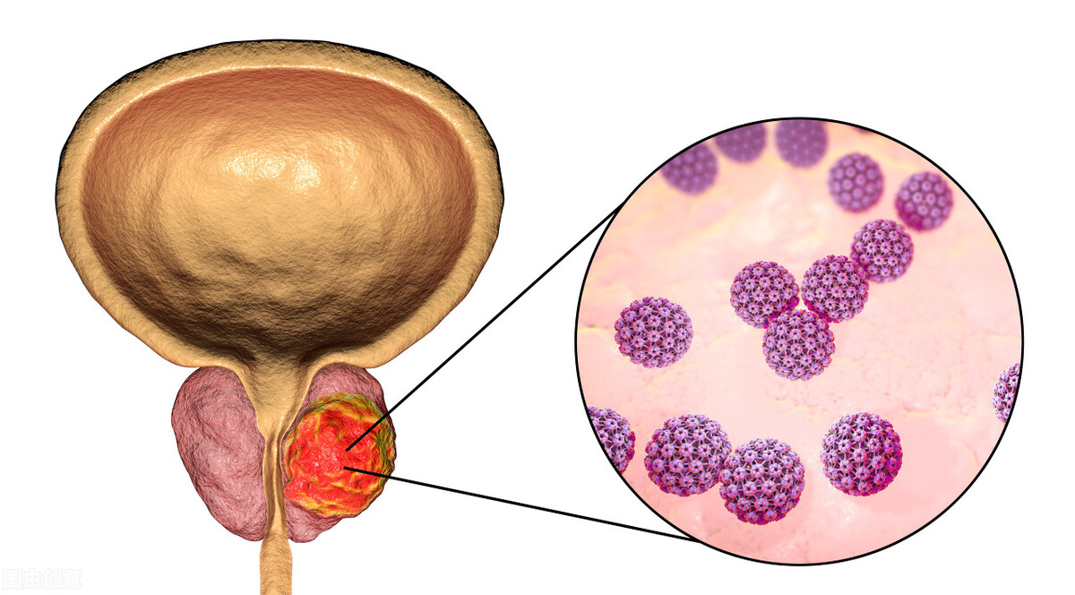 女性感染hpv病毒是丈夫出轨了吗,女性感染hpv病毒是不是老公出轨了
