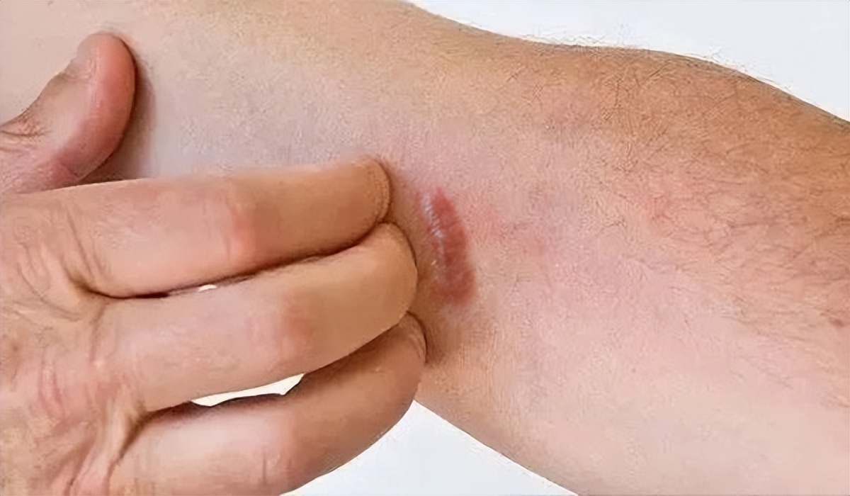 疤痕痛痒中医怎么治疗,疤痕痒怎么能彻底消除