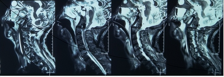 挑战骨折康复,颈椎如果摔断了会有什么后果