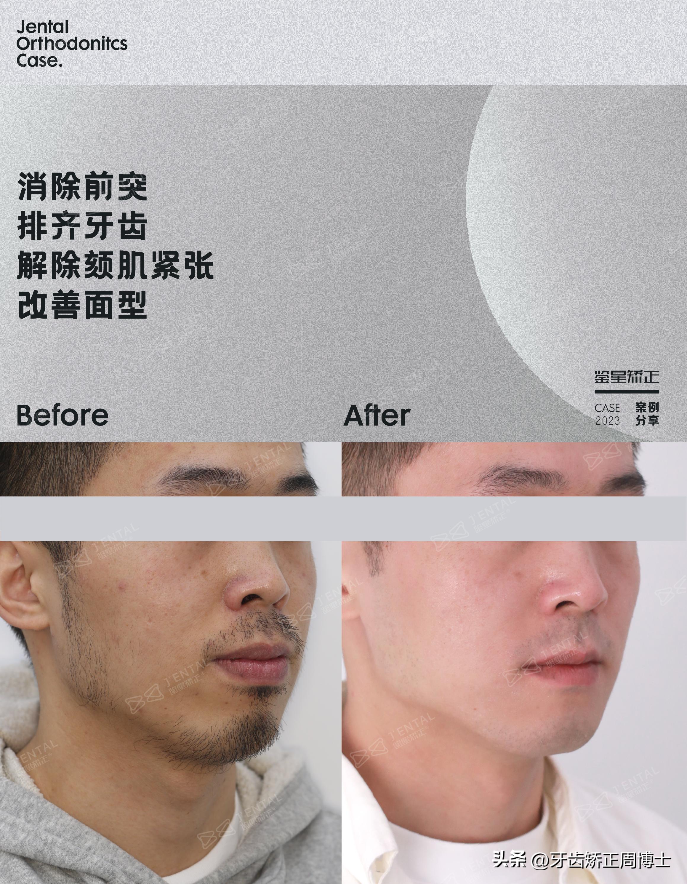 智齿正畸替代第二磨牙危害,智齿矫正代替第二磨牙3d图