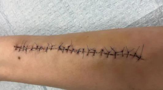 洗纹身真的不是一般人能承受的,洗纹身真的要下很大的决心