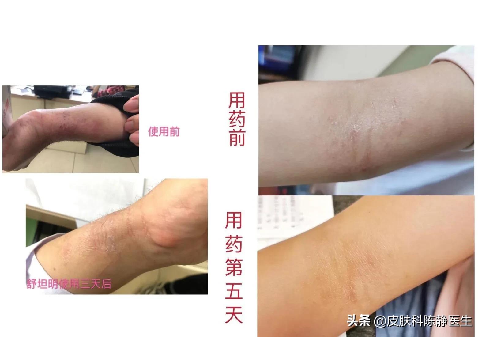 克立硼罗软膏是新药吗,克立硼罗软膏能治光敏性皮炎吗