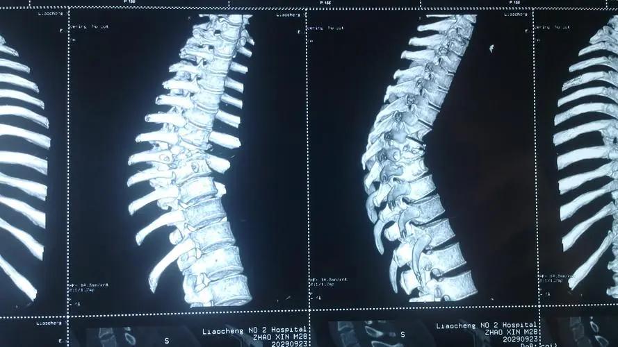 胸椎正骨推拿手法,中医胸椎推拿手法全套教程