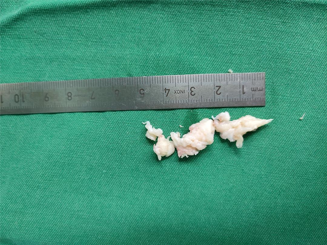 腰椎间盘突出怎样让它缩小,腰椎间盘突出最快缓解方法学生