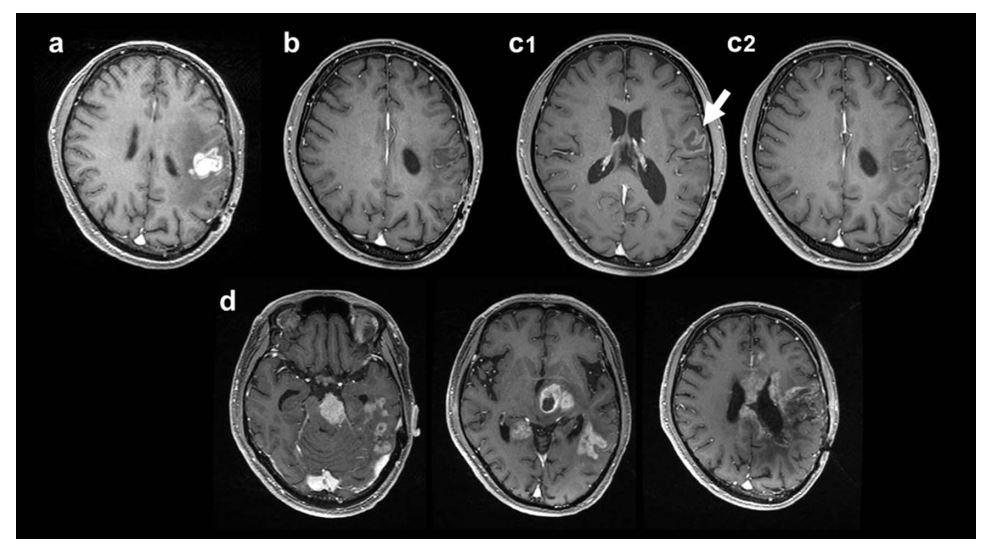 硼中子俘获疗法（BNCT）联合贝伐珠单抗治疗复发恶性胶质瘤