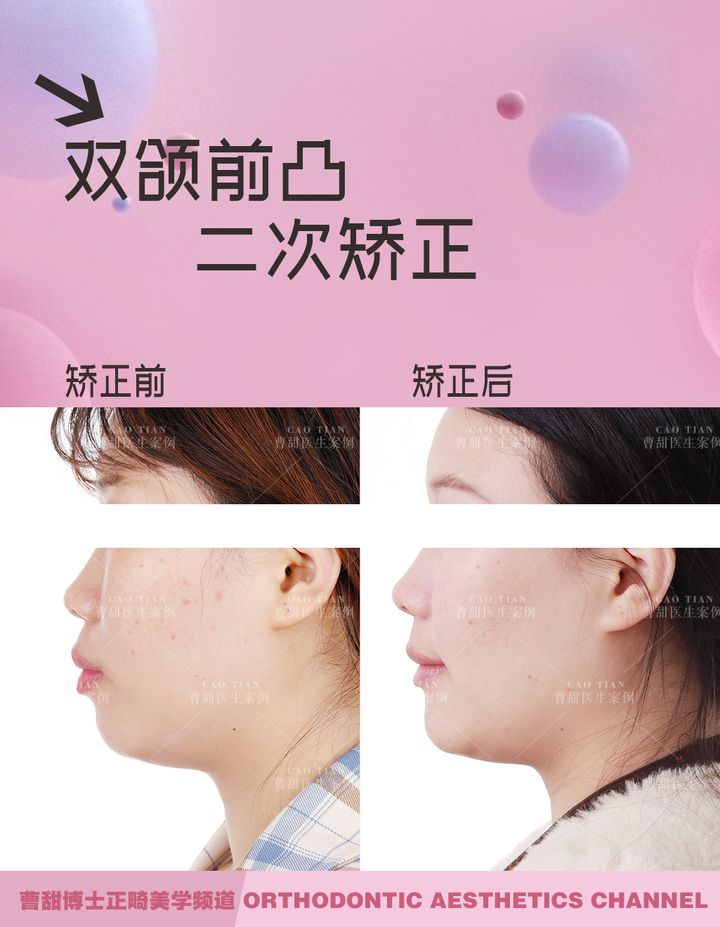 不拔牙矫正嘴凸下巴后缩案例,嘴瘪不拔牙矫正嘴会凸怎么办