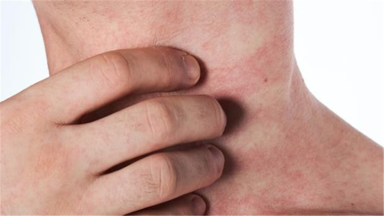 不要错把艾滋病当皮肤病，皮肤出现3种情况，或是艾滋发出的信号