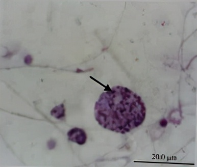 uu感染会自愈么,uu感染是hiv吗