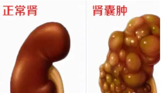 朱半仙遗留的一个千金特效方，消散各种结节，男女都适用