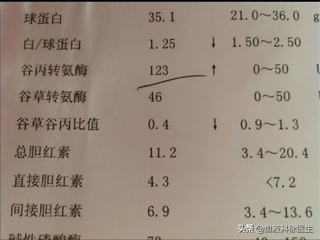 谷丙转氨酶53谷草转氨酶43严重吗,谷草转氨酶和谷丙转氨酶高会怎样