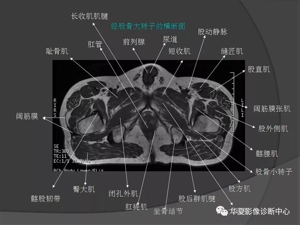 女性盆腔ct连续断层解剖图,盆腔mri影像病例分析