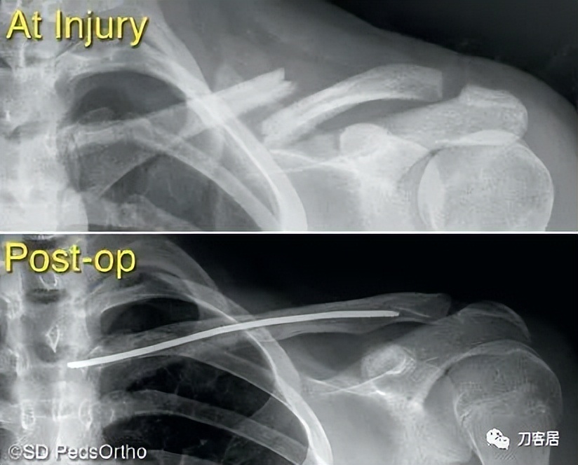 儿童锁骨骨折保守治疗的弊端,锁骨粉碎骨折错位不处理会愈合吗