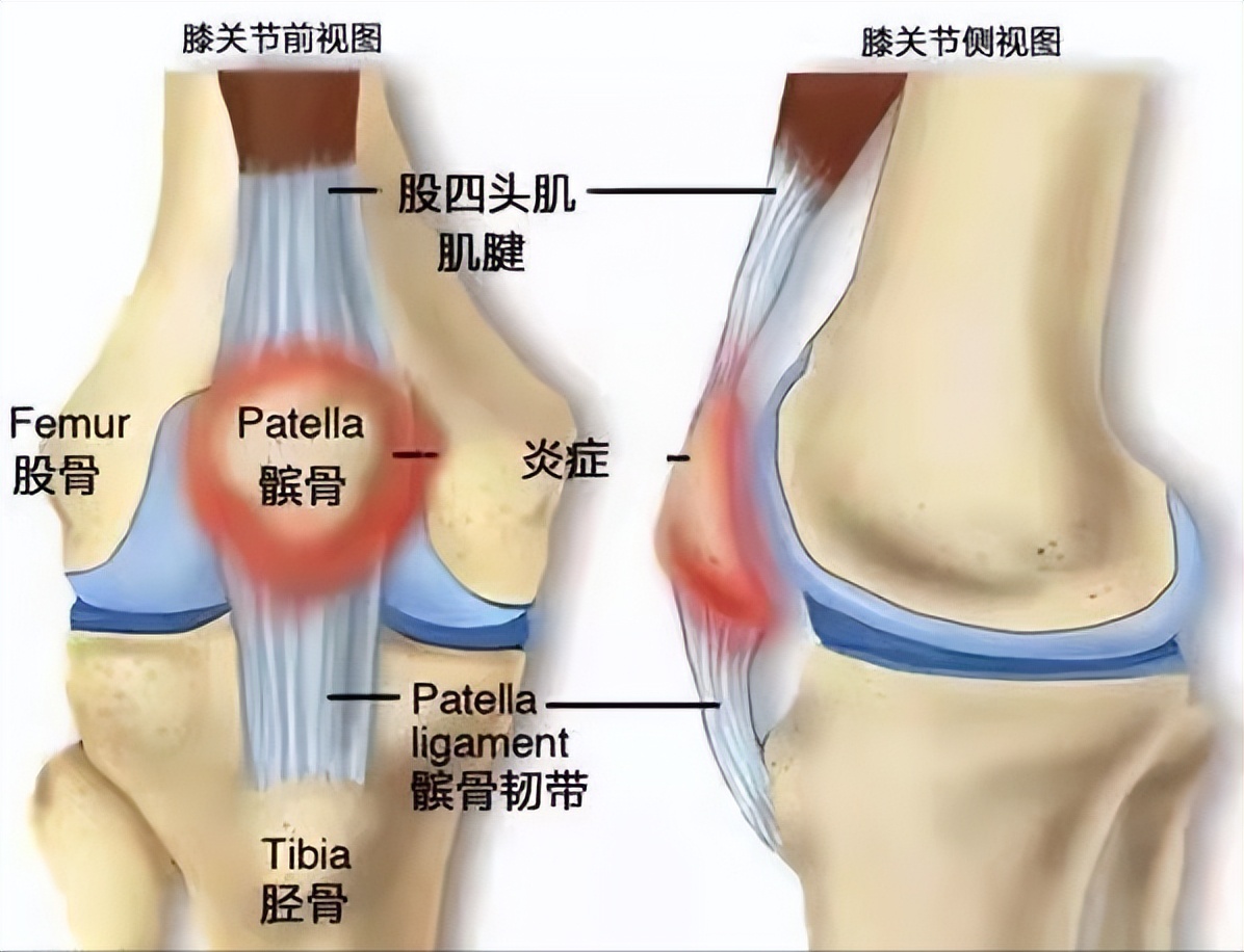 髌骨软化症走路腿发软没劲严重吗,上下楼梯膝盖疼屈膝疼怎么回事