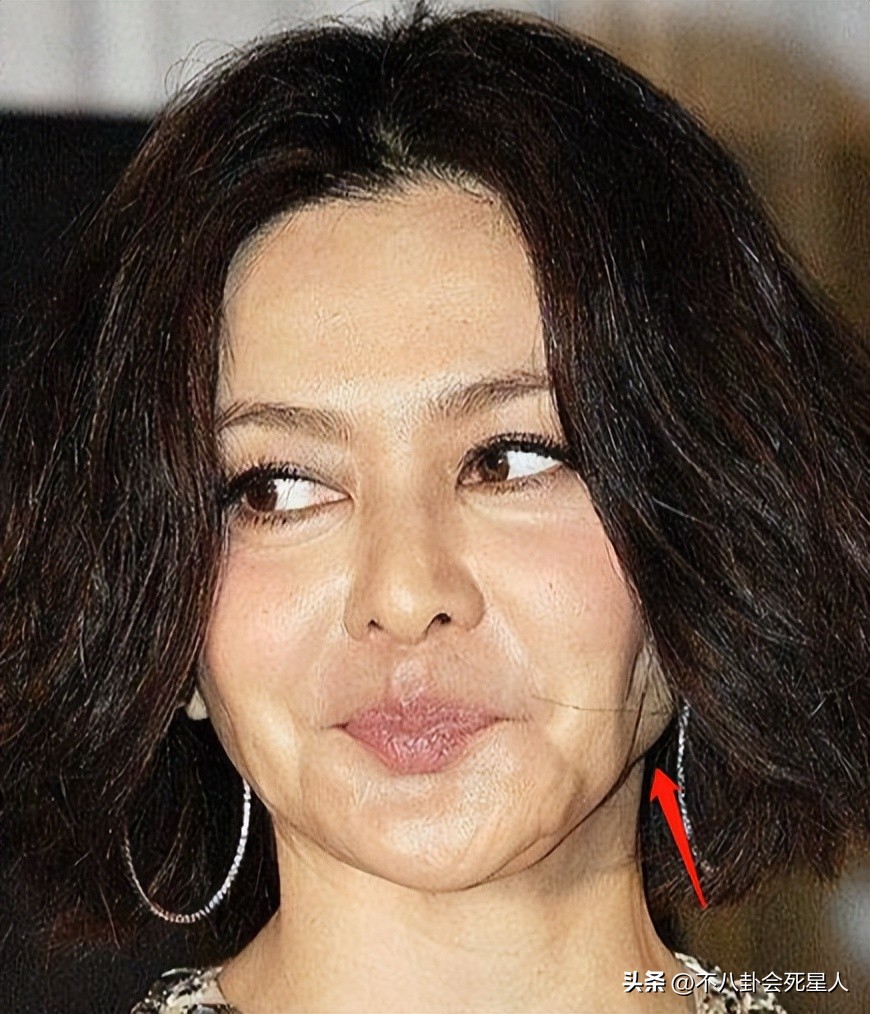 拉皮的女明星后遗症,拉皮失败的明星