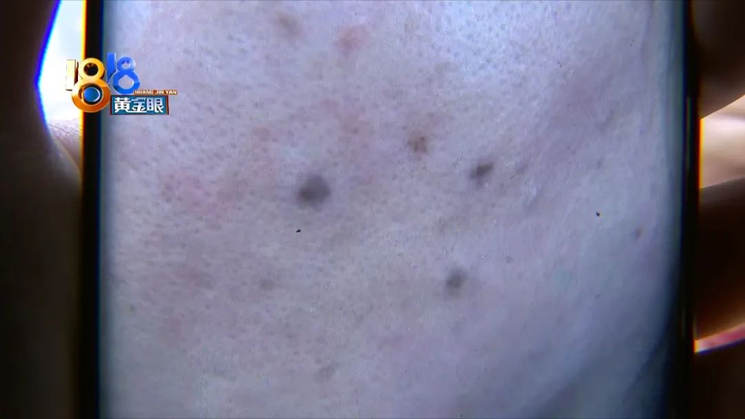 顾客说点痣后留坑怎么回复,激光点痣太深留下坑