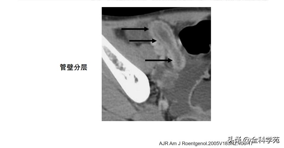 阑尾炎的讲解,关于阑尾炎的讨论总结