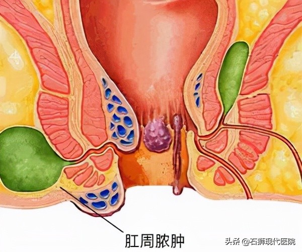 肛肠科十大疼痛之肛周脓肿,肛窦炎引起的肛周脓肿多久能好