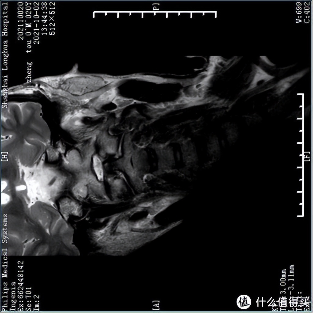 颈椎枕对颈椎病有用吗,记忆枕对颈椎好吗