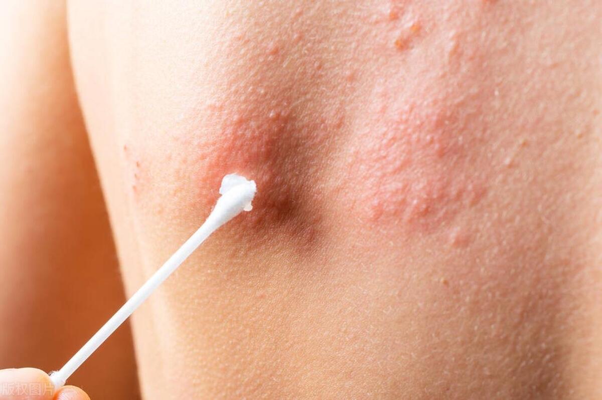 生蛇病难治好吗,生蛇的水泡怎样处理