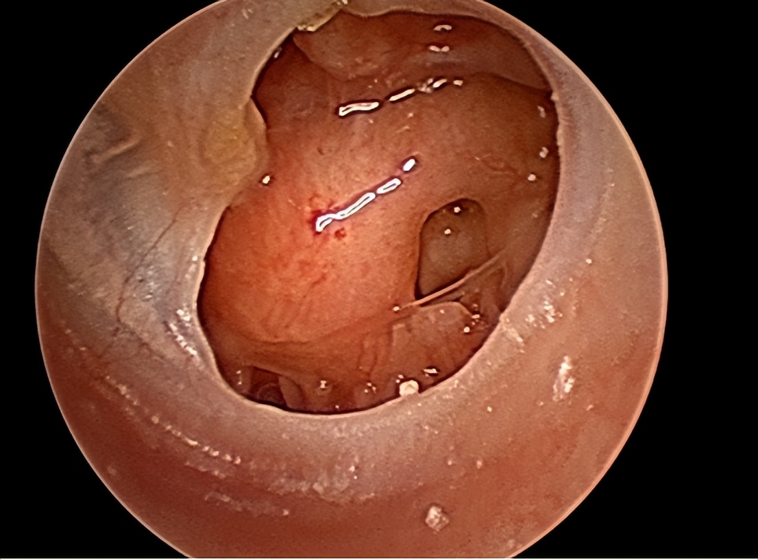 分泌性中耳炎是什么，为什么儿童得病几率更大，要怎么治疗