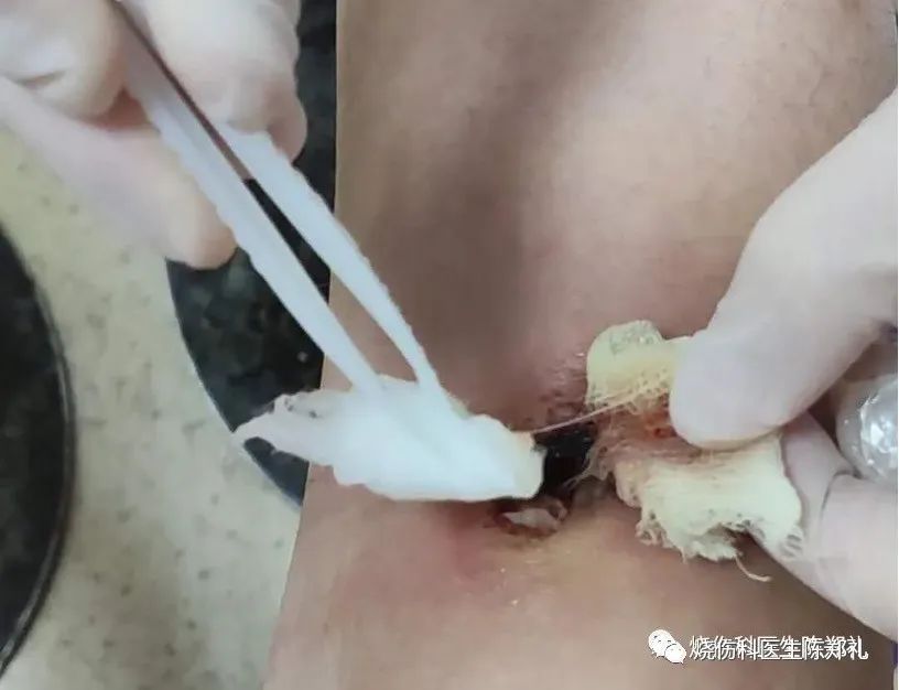 创面外用药物及敷料的使用策略及理论依据