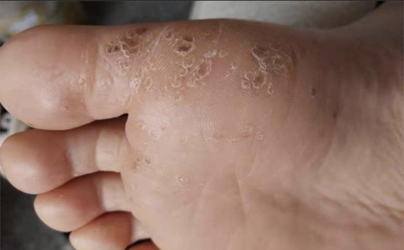 跖疣冷冻破了怎么办,跖疣反复冷冻不好怎么处理