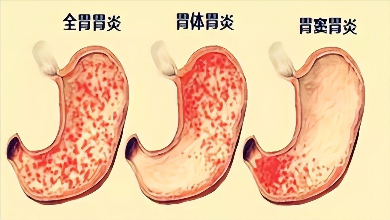 胃炎三分治七分养，医生直言：胃炎患者改善饮食才是最大的良药