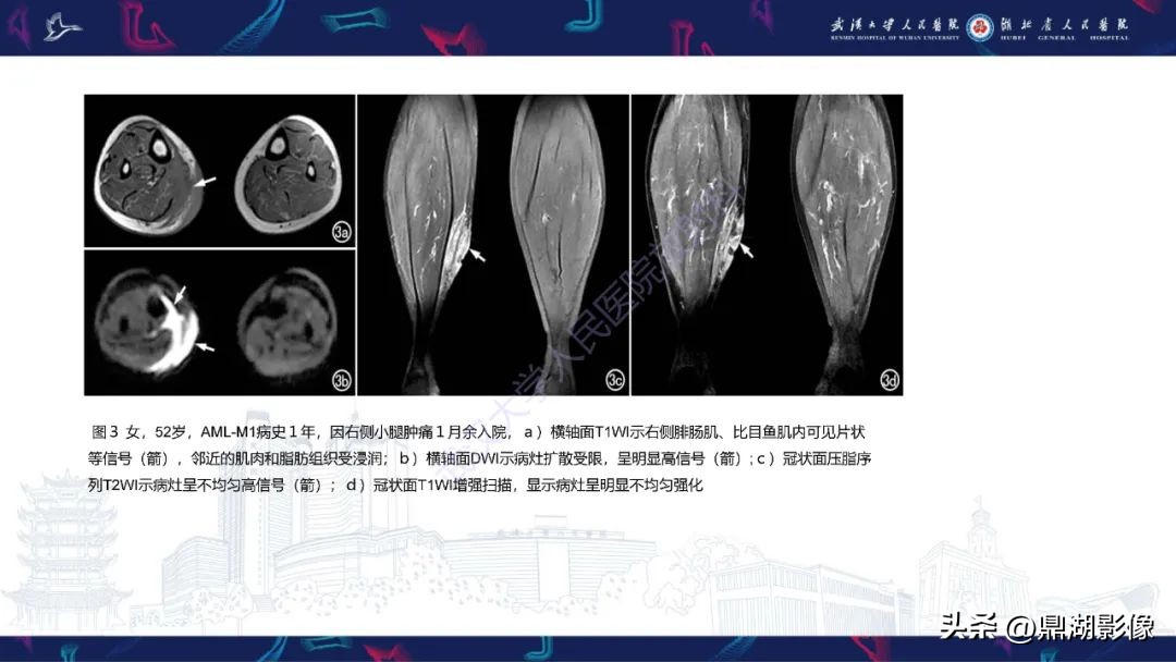 阴道里长肉瘤是啥症状,阴道肉瘤症状