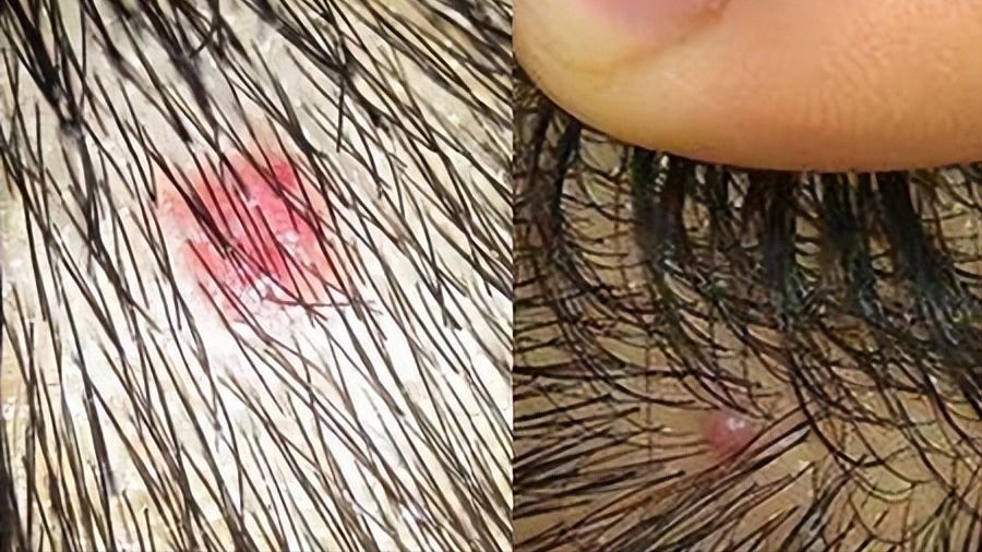 头皮上长红疙瘩脓包涂什么药膏,头皮上长红疙瘩脓包用什么药