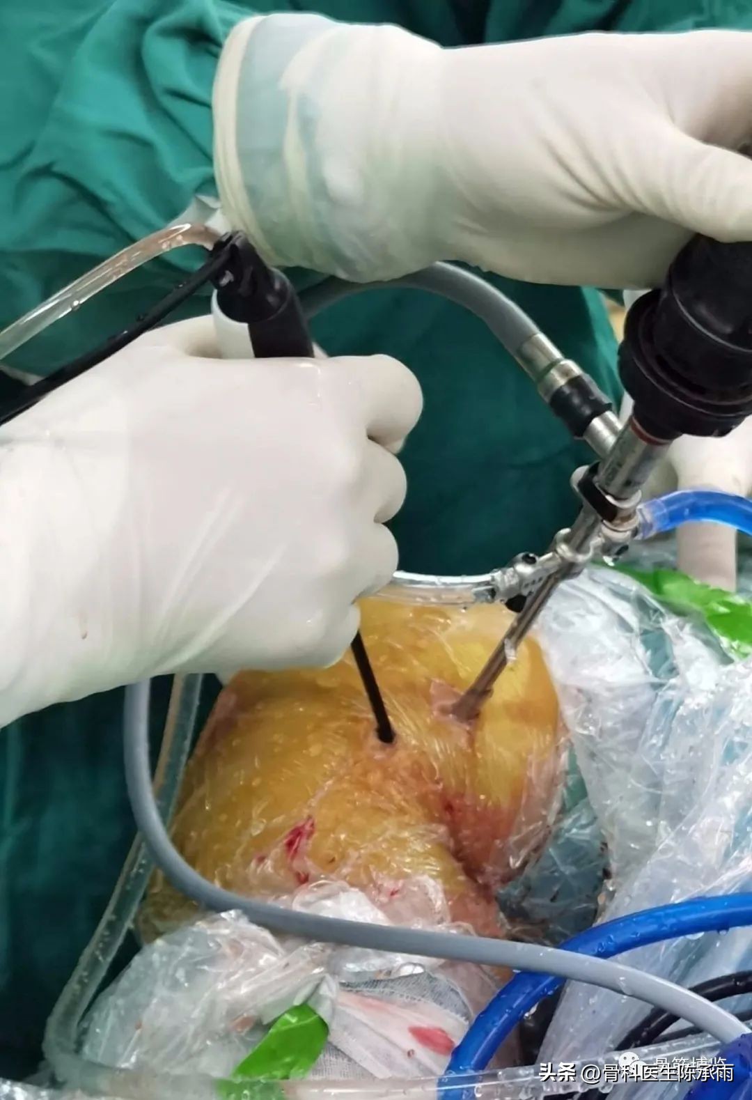 腘窝囊肿关节镜下切除复发,膝关节镜下腘窝囊肿切除的原理