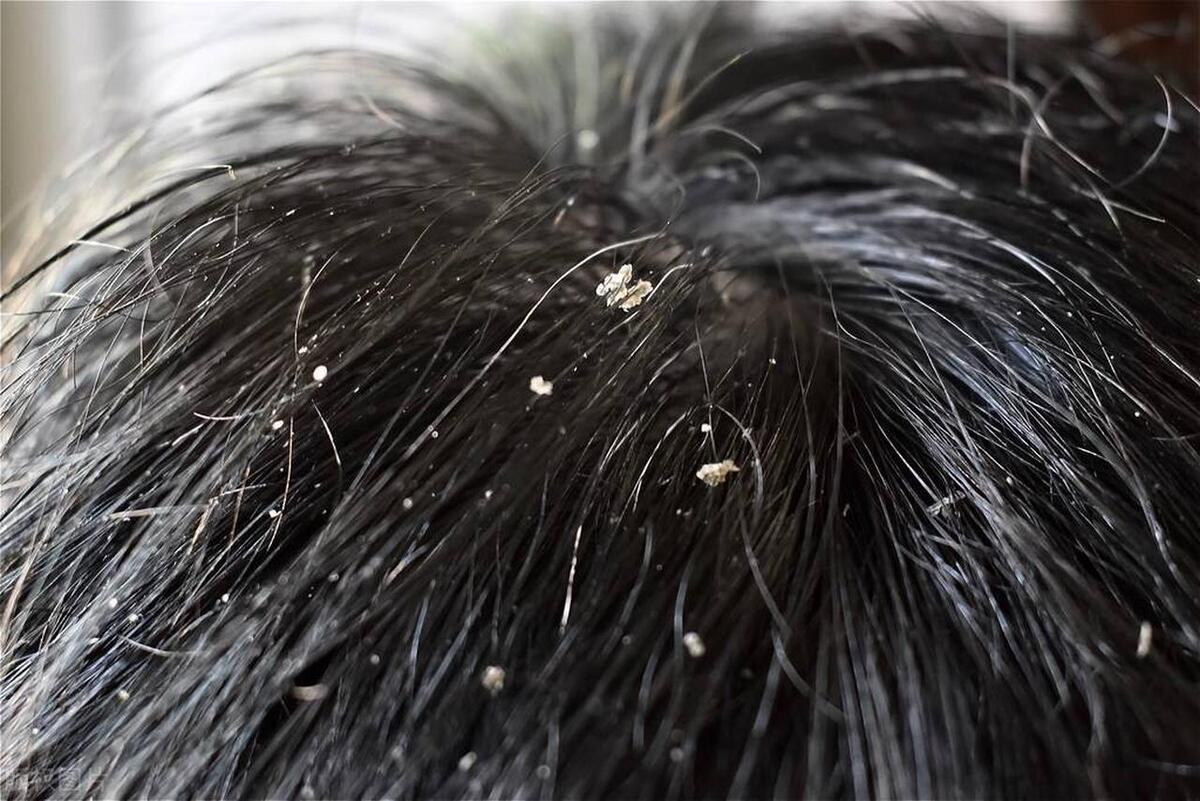 头发里有大片的头皮屑，这是怎么回事？