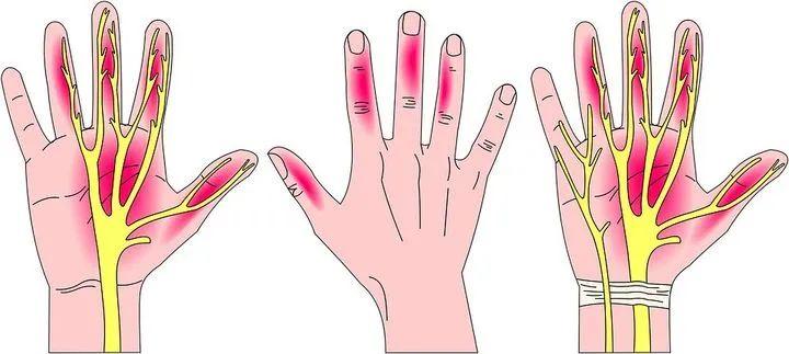 手麻握不住东西怎么锻炼,手麻无力最快的恢复手法