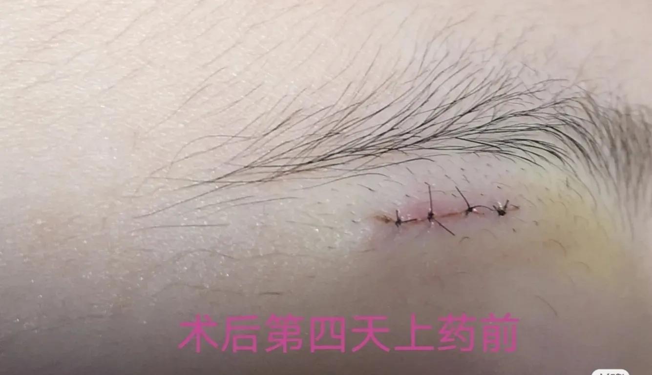 孩子头部皮脂腺囊肿能保守治疗吗,孩子面部皮脂腺囊肿