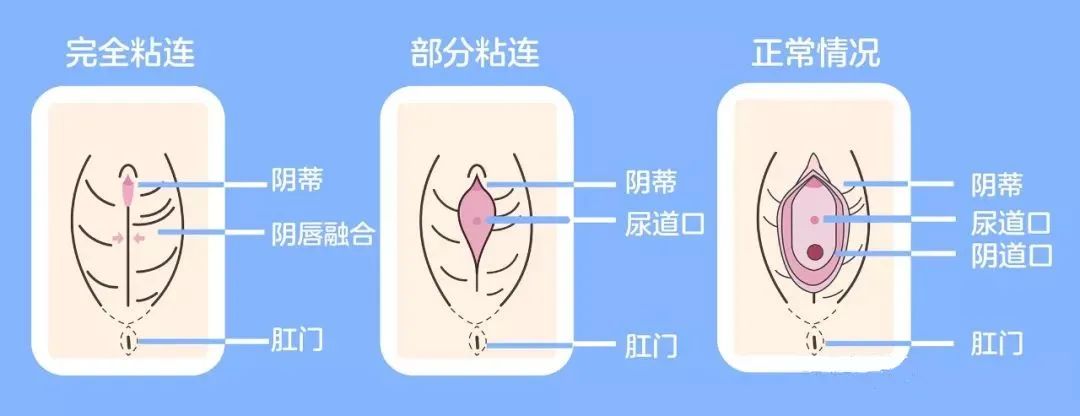 医生说小女孩要看妇科,女婴看妇科