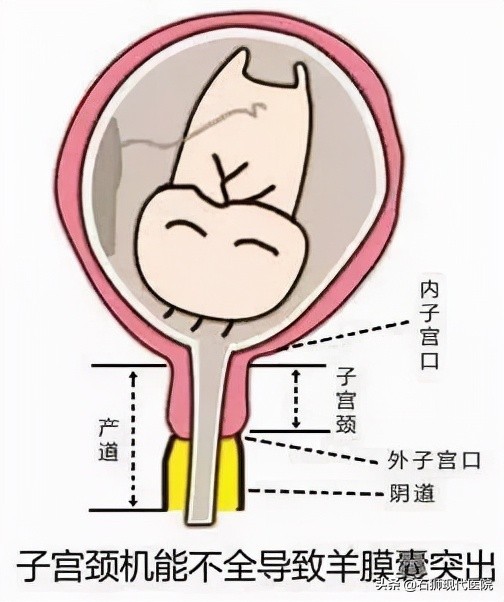 反复流产小心黄体功能不全,反复流产不要忽视男性因素