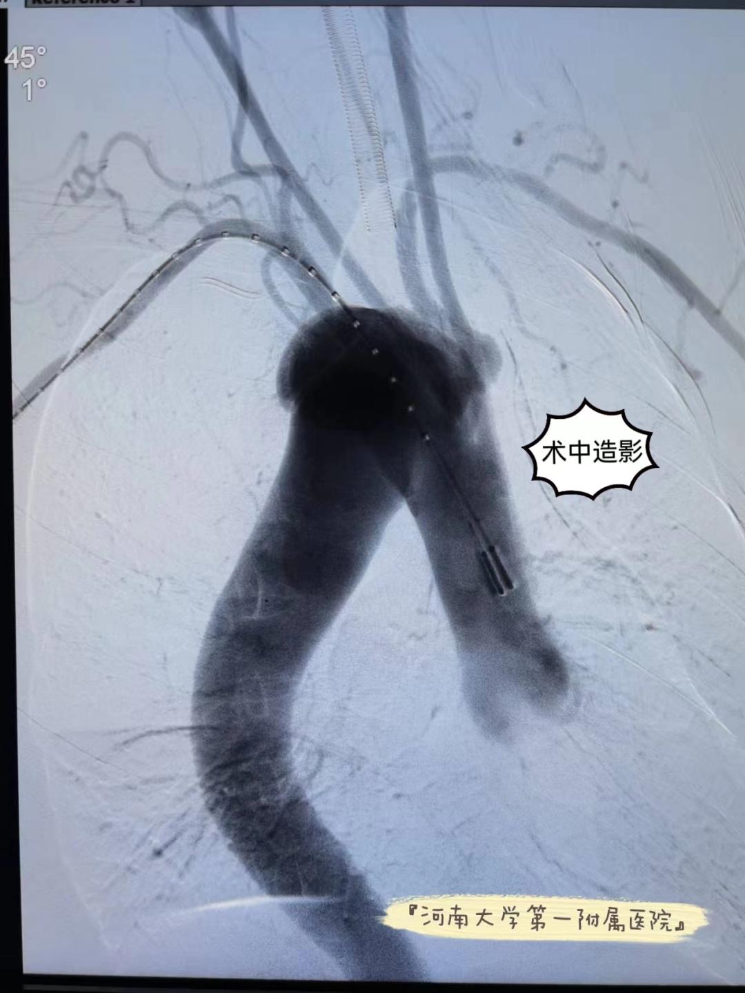 主动脉夹层救活的几率大不大,主动脉夹层腔内重建修复术