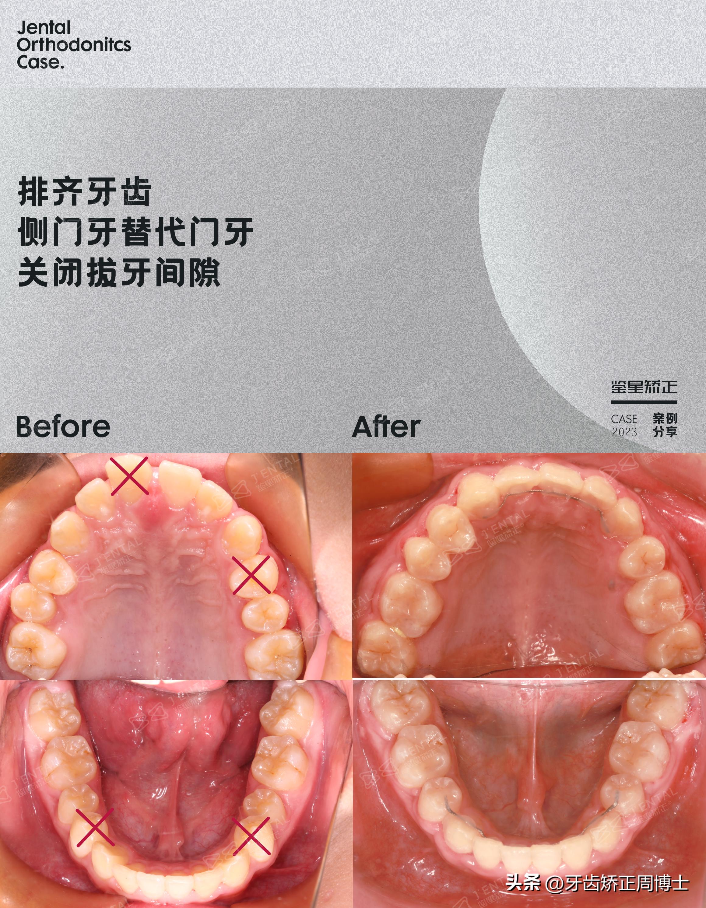 拔掉大牙做矫正好还是植牙好,拔掉4颗牙齿正畸收缝有几种方法