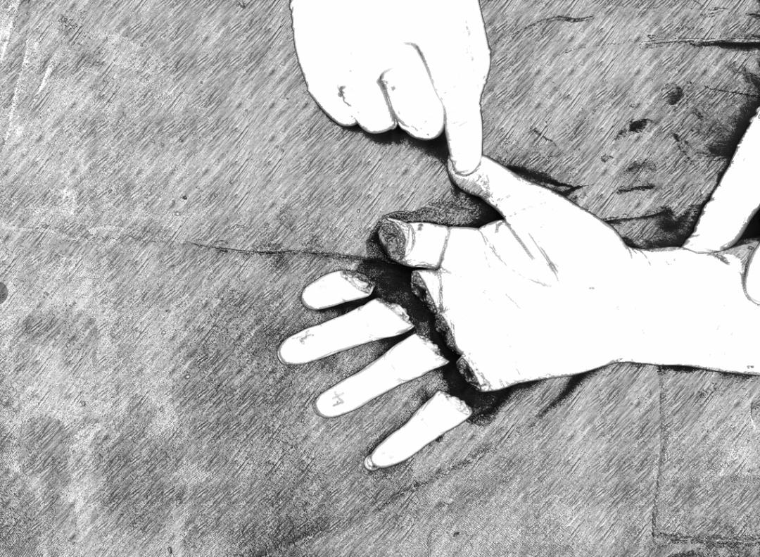 一瞬间，4根手指没了！浙一专家：意外来临时，千万记得这样做